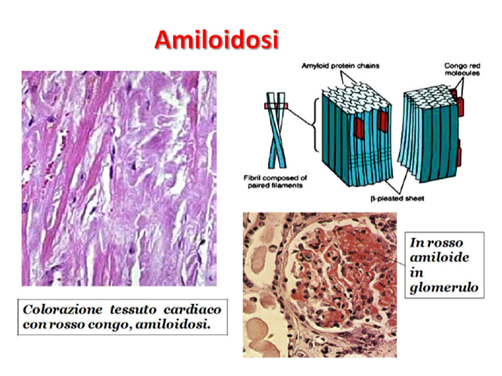amiloidosi:-cause,-sintomi-e-rischi-di-una-patologia-fortemente-invalidante.